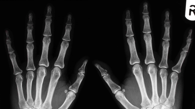 x-ray image of a person's hands