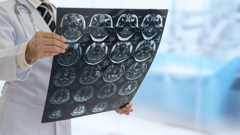 Doctor looks at a sheet of film containing CT scan images of the brain
