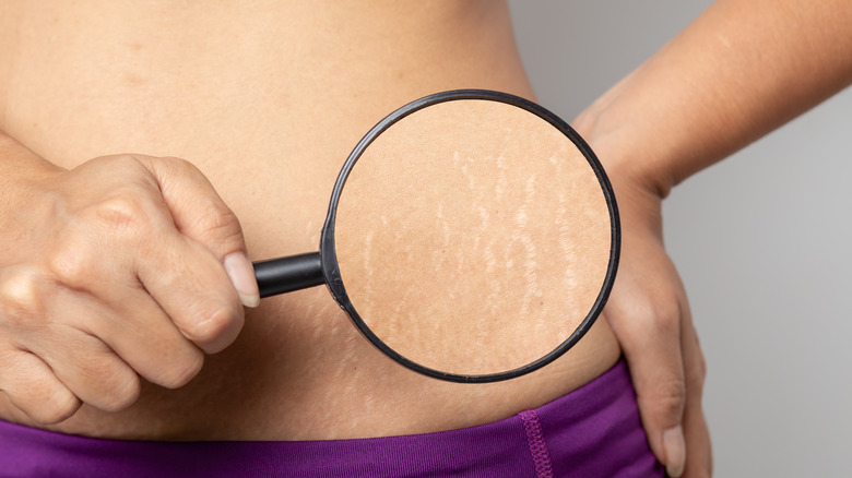 magnifying glass showing stretch marks
