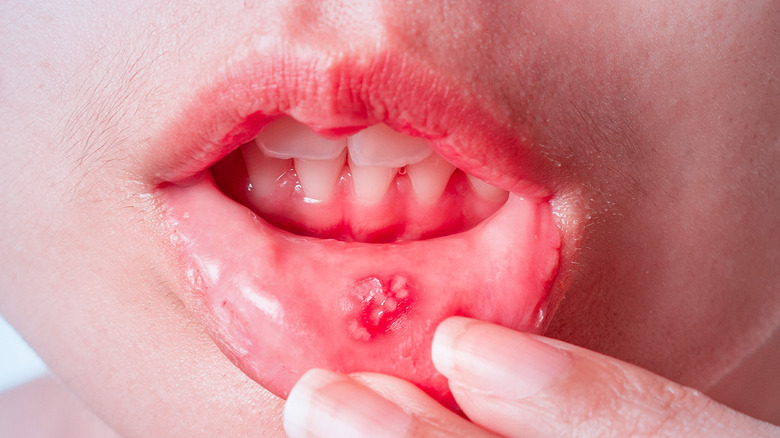 close up of mouth ulcer on lip