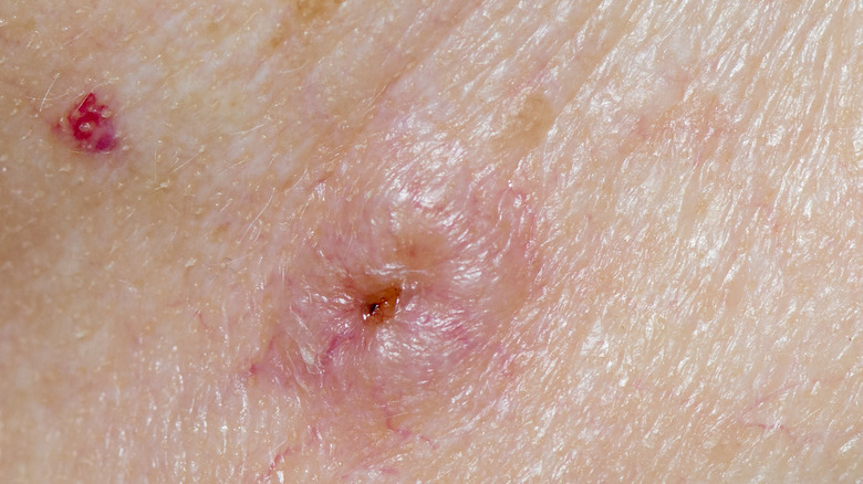 close-up of skin infection