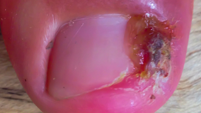 close-up of toe with mrsa