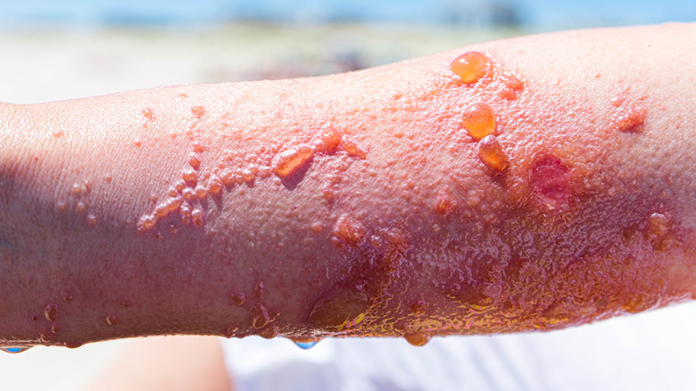 arm with oozing poison ivy rash all over