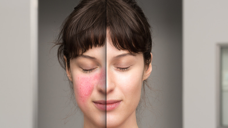 Woman with rosacea