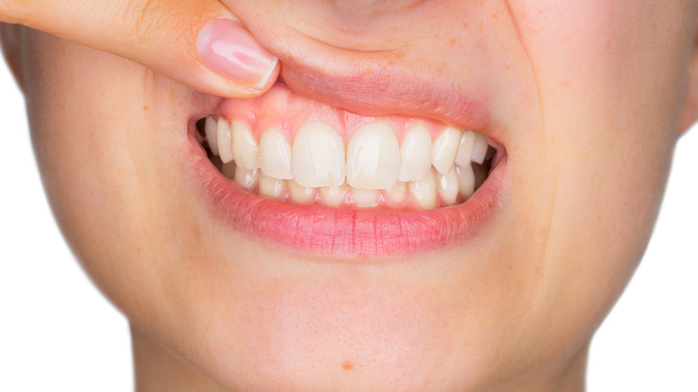 Woman lifting upper lip to show gums