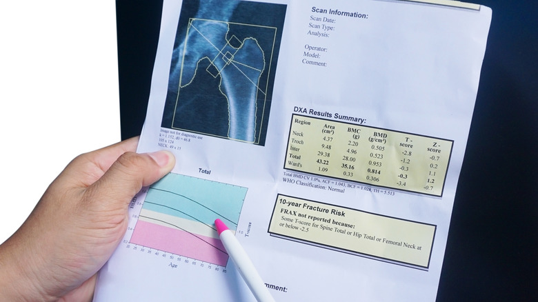 doctor examining dexa scan