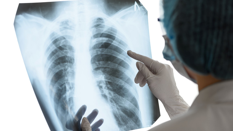 Doctor inspects X-ray of lungs