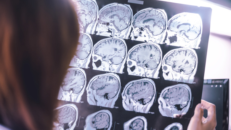 Brain scans showing cerebral atrophy