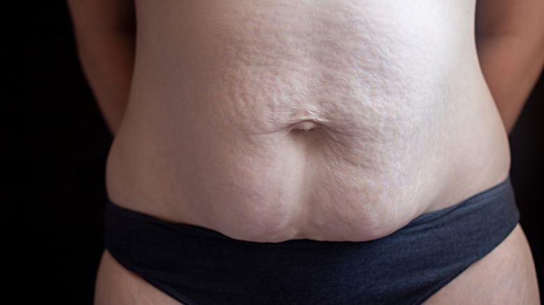 What Is Diastasis Recti And How Can You Treat It?