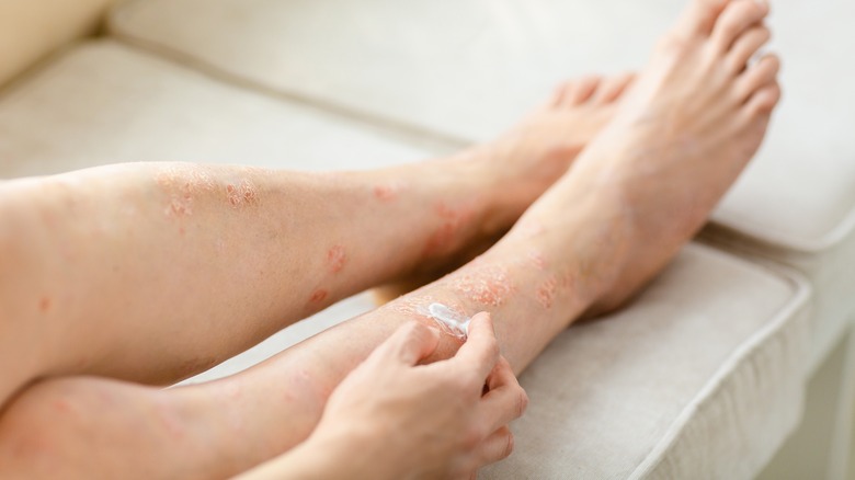 Person applying cream to psoriasis 