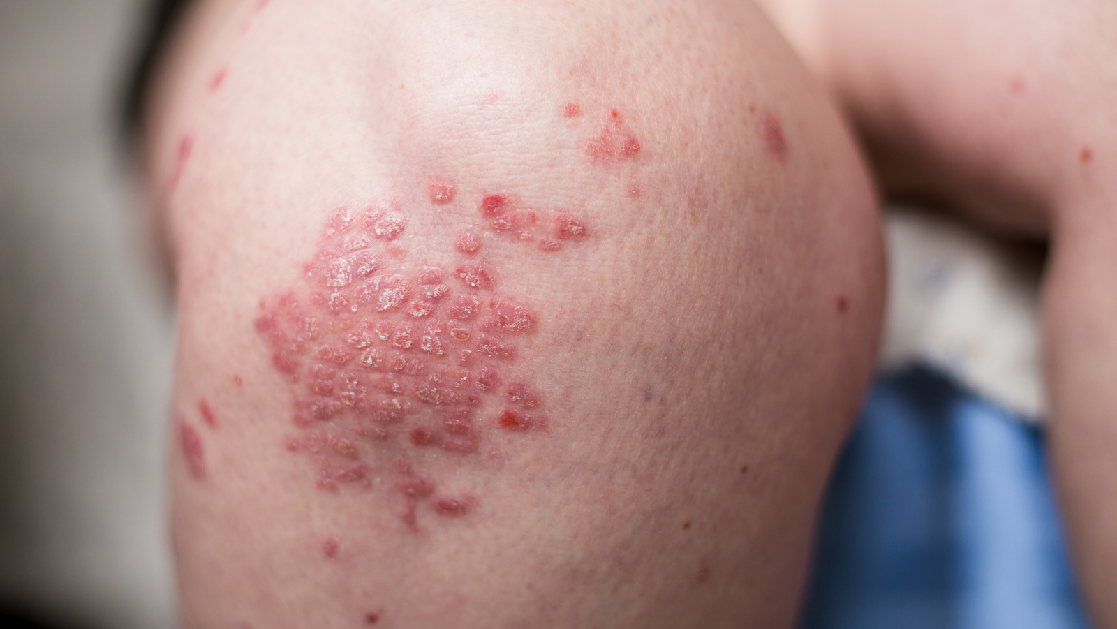 what-is-plaque-psoriasis