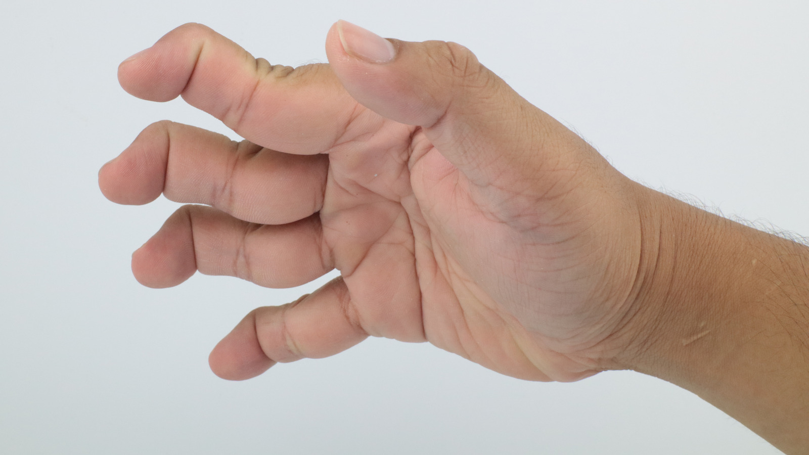 Swan Neck Deformity Of The Finger Physiodc - vrogue.co