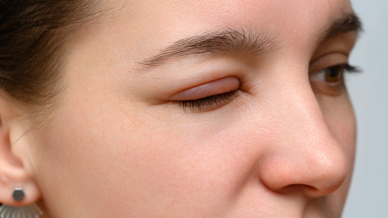 woman with a swollen eyelid