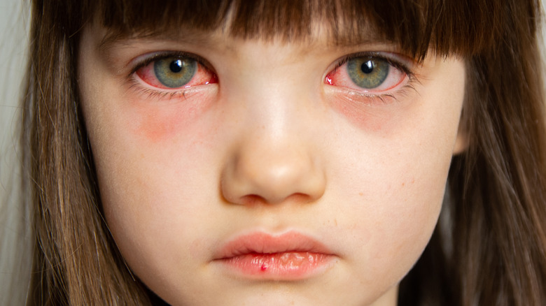 Child with pinkeye