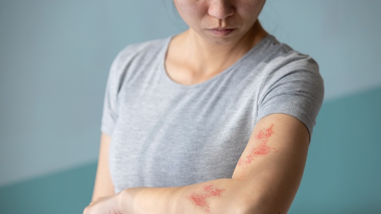 Person with shingles on skin