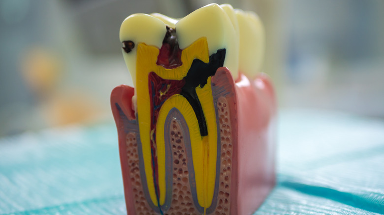 model of tooth with pulpitis