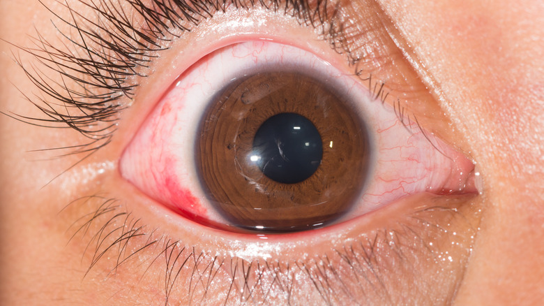 Subconjunctival hemorrhage