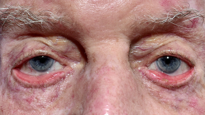 Elderly man with ectropion