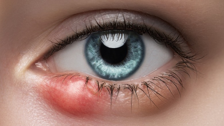 Close up of an eye with a stye