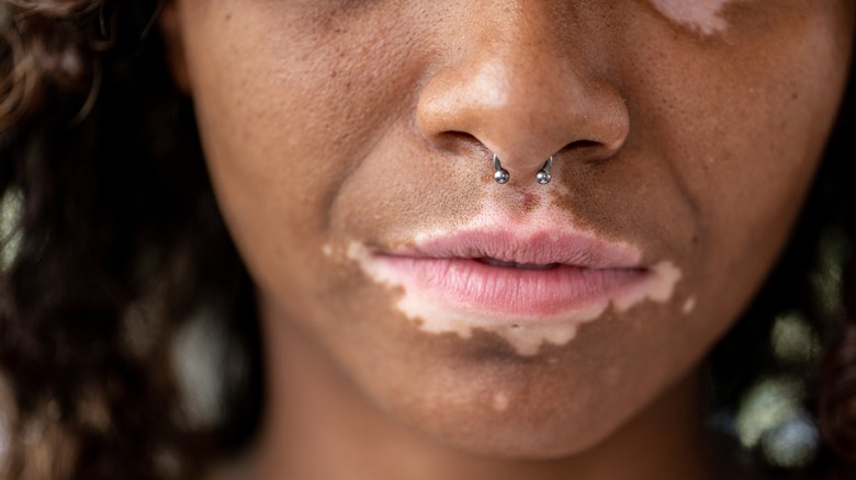 Woman with vitiligo on lips