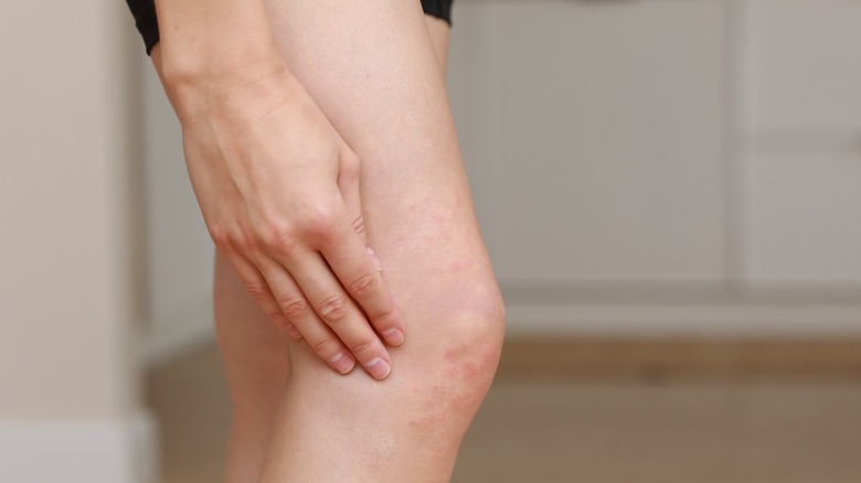 woman with rash on legs