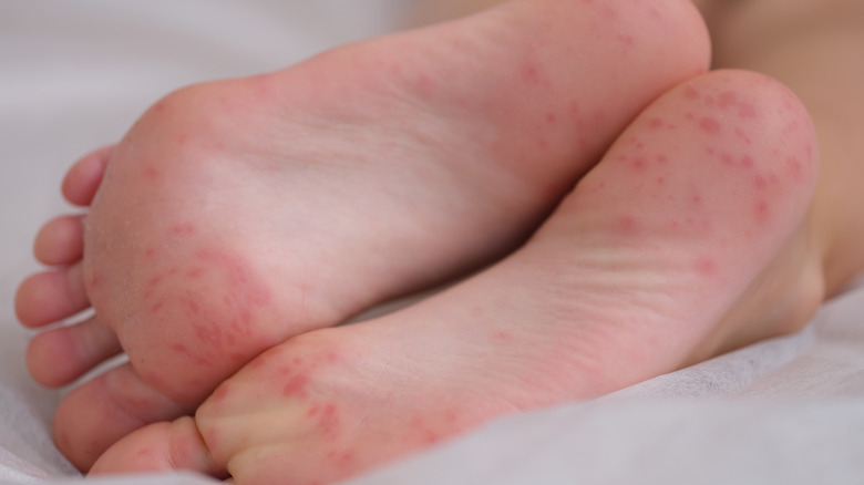 feet of child with allergic rash