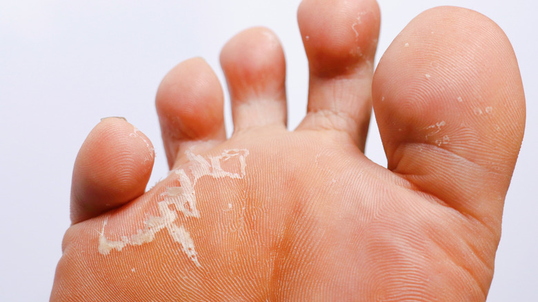skin peeling due to athlete's foot
