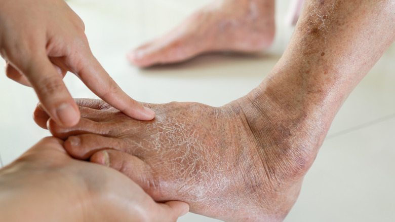 dry, cracked skin of elderly woman 