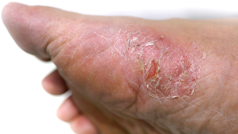 close-up of foot psoriasis