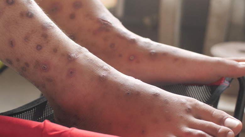 scabies on feet and lower legs