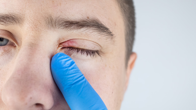A doctor examines a patient with blepharitis
