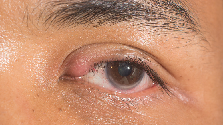 Close up of an eye with a chalazion
