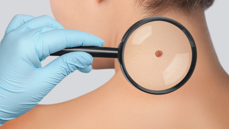 neck mole with magnifying glass