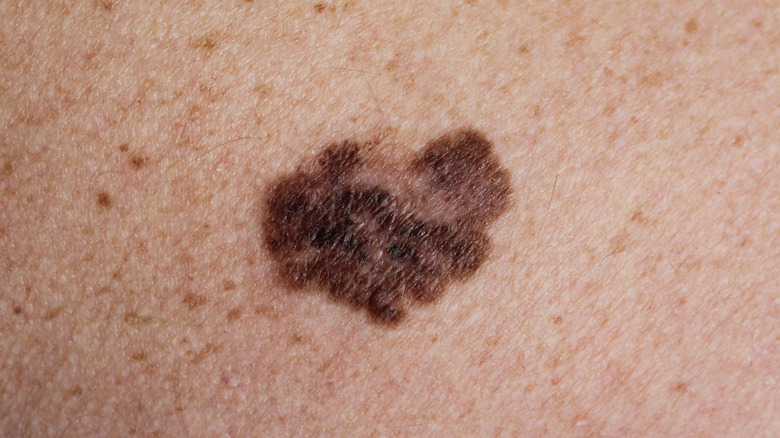 Mole on skin 