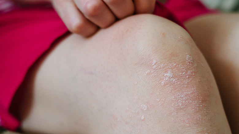 Eczema on knee