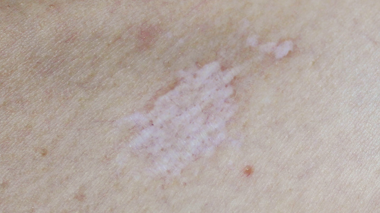 Spot of lichen sclerosus on skin