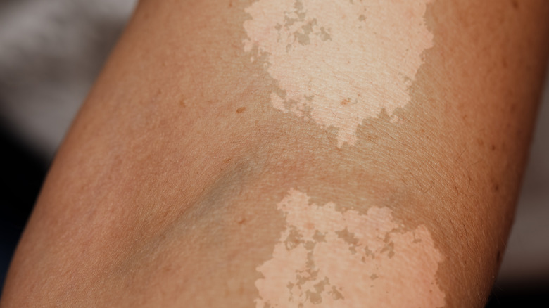 Tinea versicolor spots on arm