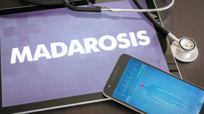 the word "madarosis" on an iPad in a clinical setting 