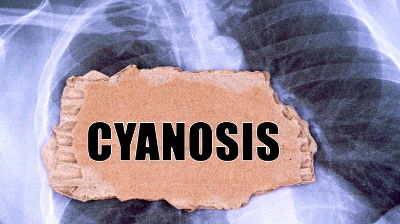 Sign reading "cyanosis" in front of a chest x-ray