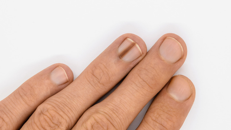 Black streak on the nail of the ring finger