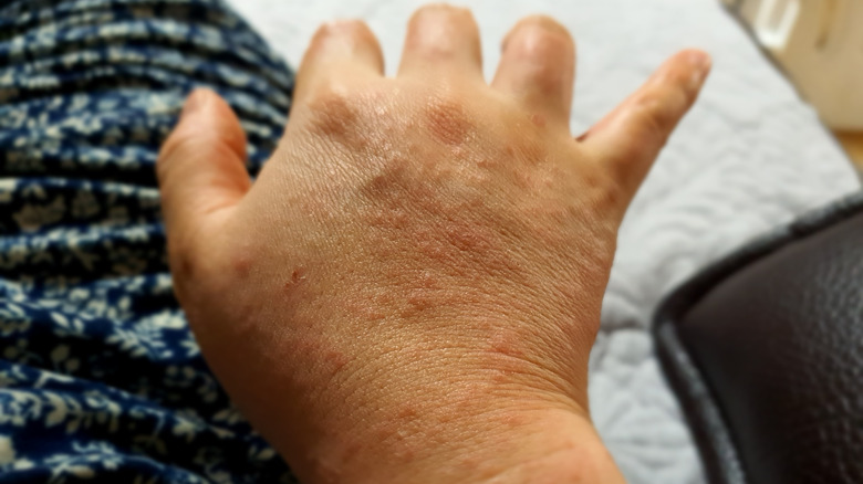 Skin rash on a hand