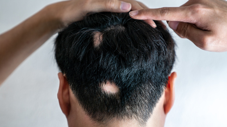 Top more than 69 patchy hair loss - in.eteachers