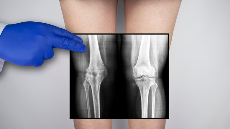 What It Really Means When Your Knees Pop