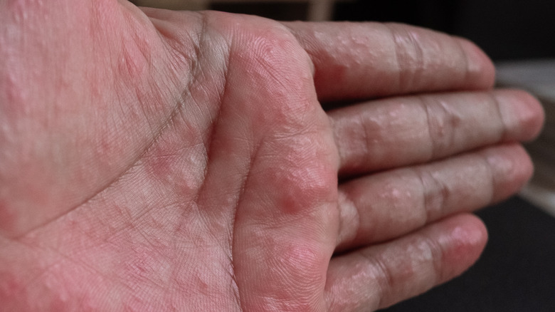 Eczema and palmar erythema on hand