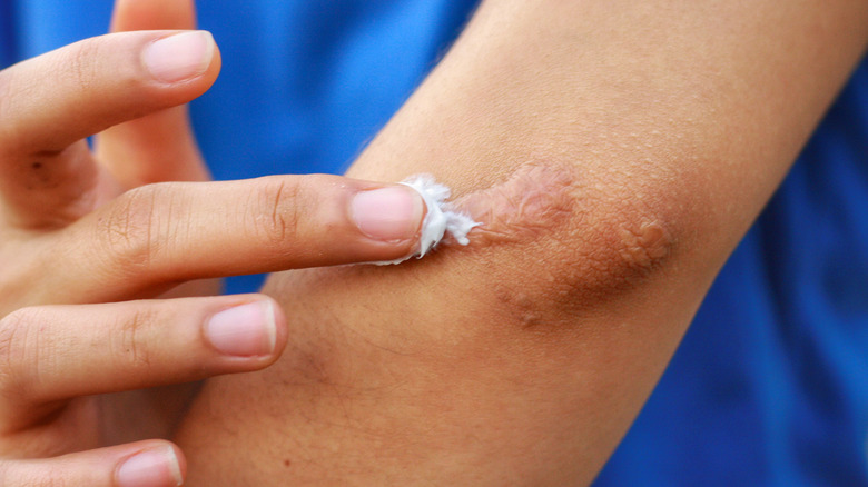 Woman putting lotion on scar