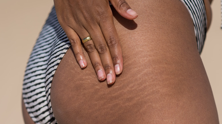 woman touching stretch marks