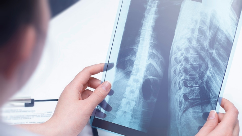 a doctor examines an x-ray of a person's spine in his office