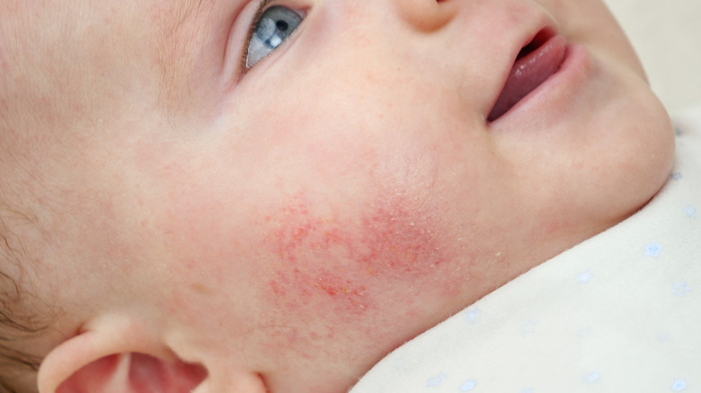 Eczema on baby's face