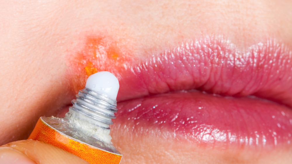 What Causes Multiple Cold Sores At Once