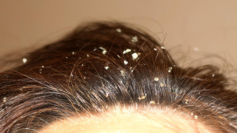 dandruff on a full hairline